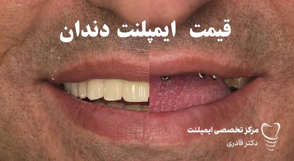 قیمت ایمپلنت دندان