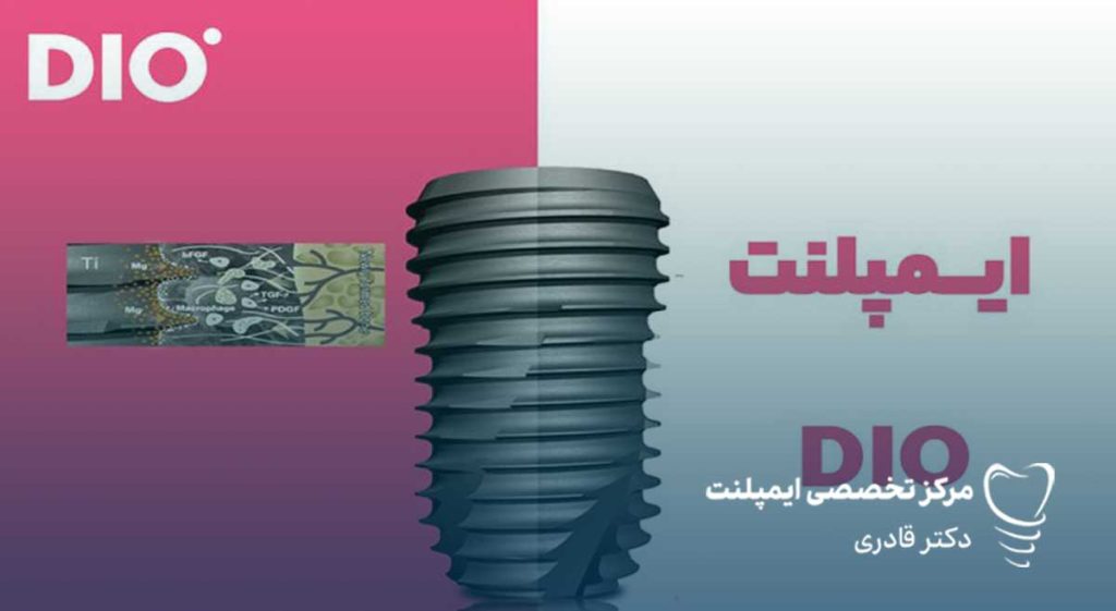 ایمپلنت dio ویژگی ها