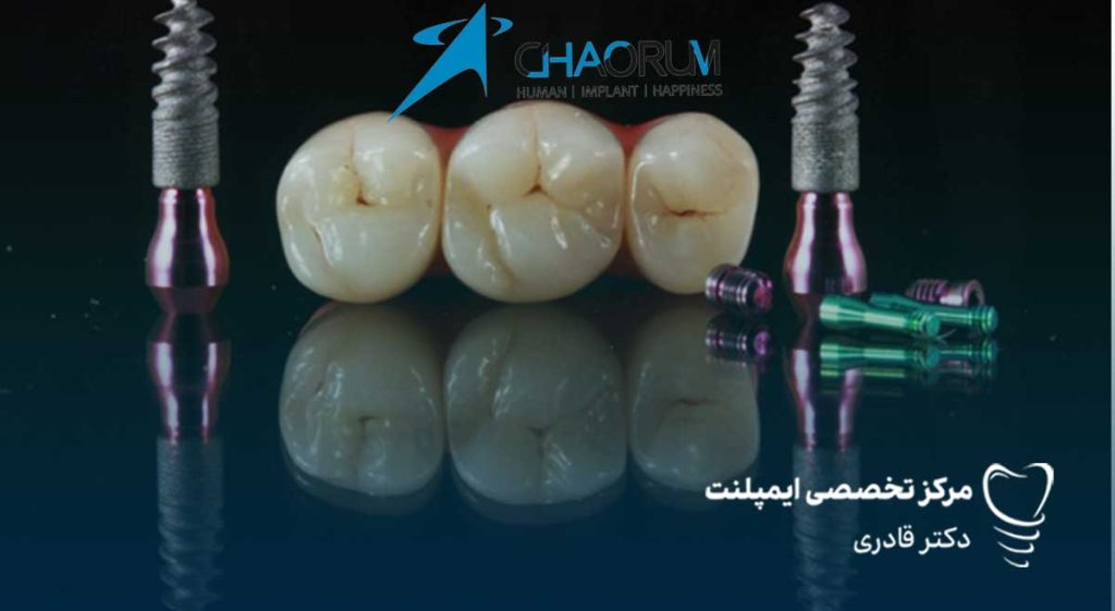 ایمپلنت چاروم و مقایسه با برندهای دیگر