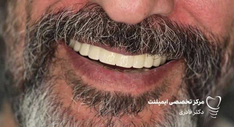 جدیدترین برندهای ایمپلنت