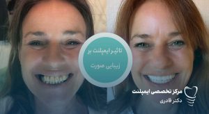 تاثیر بی دندانی بر کاهش زیبایی