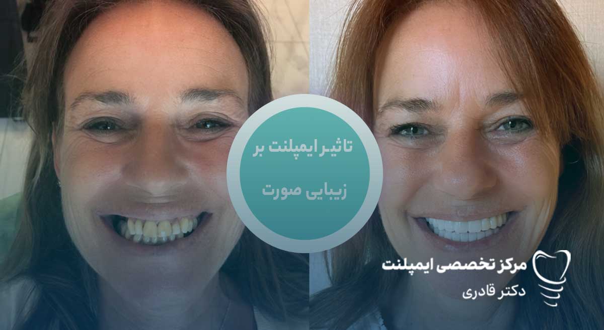 تاثیر بی دندانی بر کاهش زیبایی