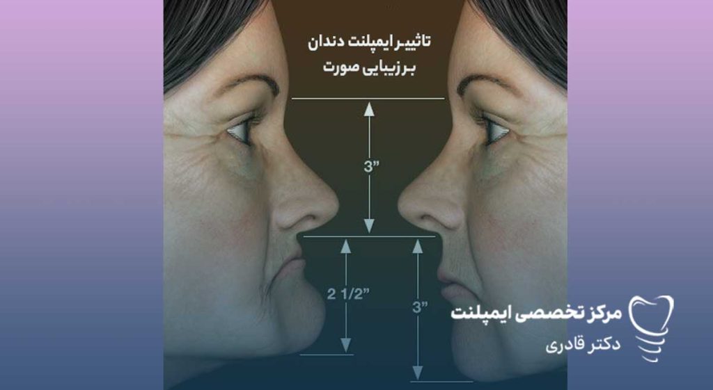 تاثیر بی دندانی بر کاهش زیبایی 