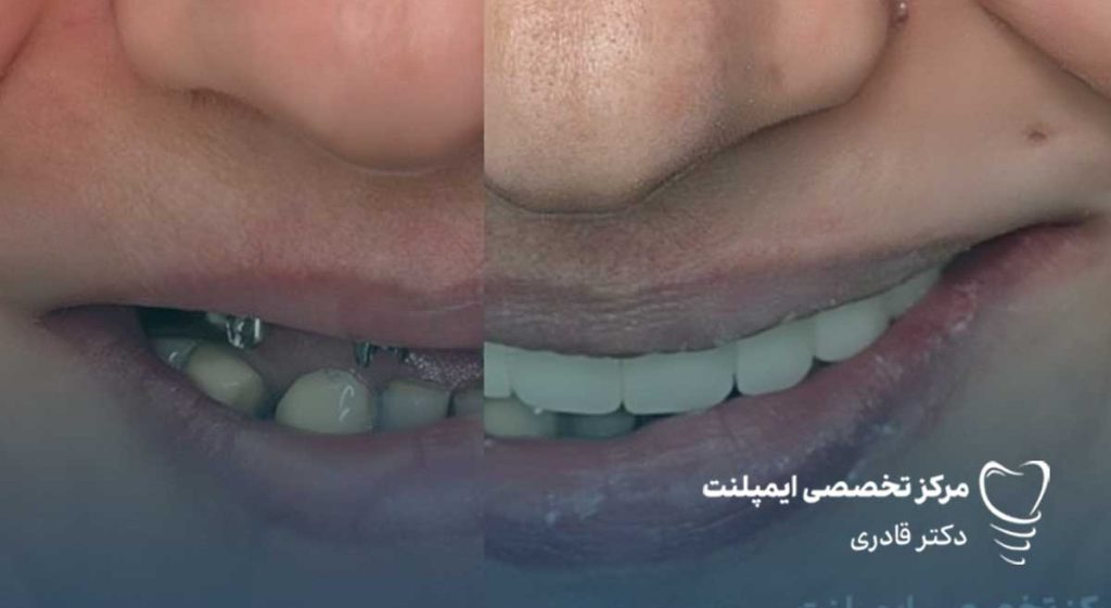 تاثیر بی دندانی بر کاهش زیبایی 