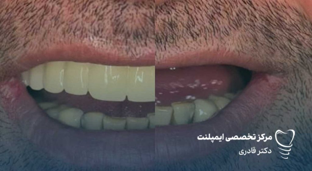 تاثیر بی دندانی بر کاهش زیبایی 