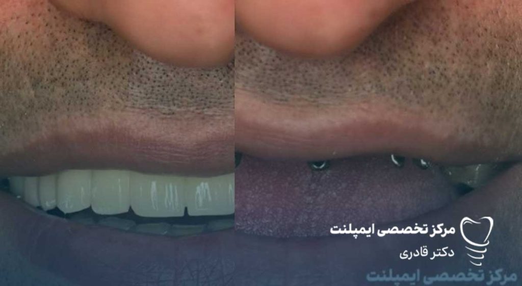 تاثیر بی دندانی بر کاهش زیبایی 