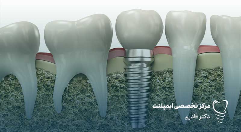 آزمایشهای قبل از جراحی ایمپلنت