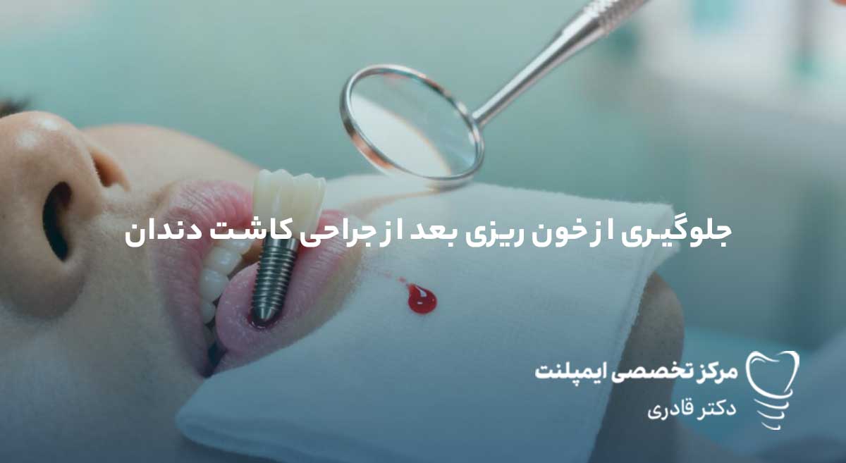 جلوگیری از خون ریزی بعد از ایمپلنت دندان