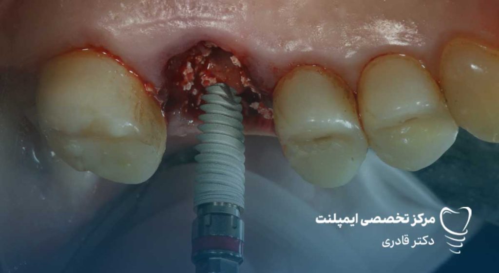 جلوگیری از خون ریزی بعد از ایمپلنت دندان