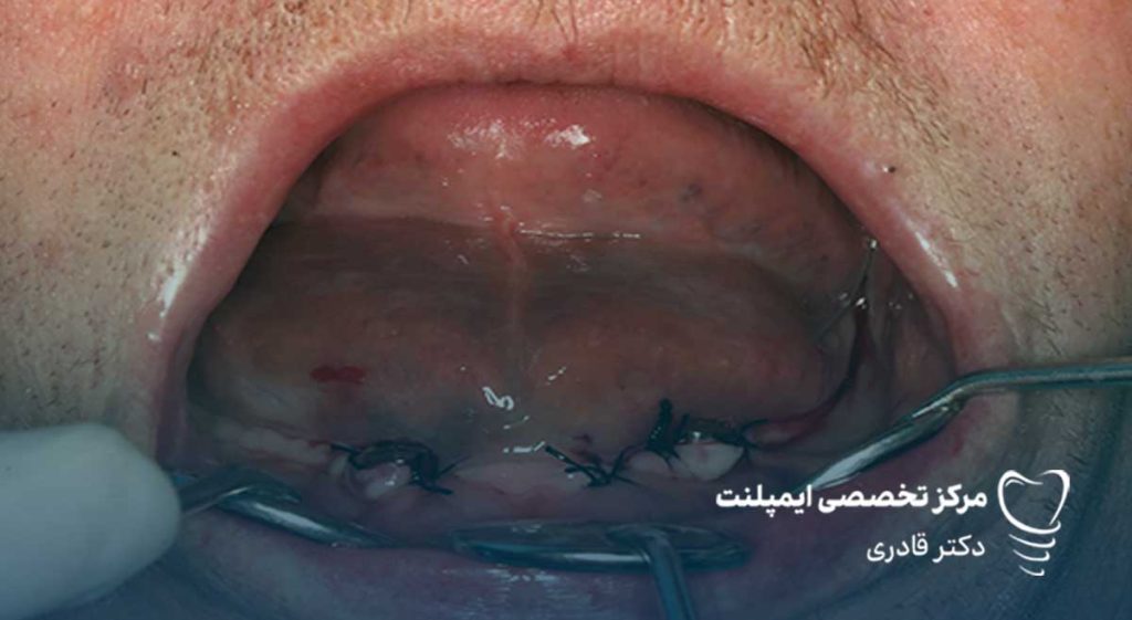 جلوگیری از خون ریزی بعد از ایمپلنت دندان