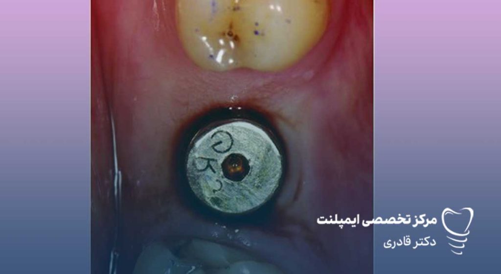 جلوگیری از خون ریزی بعد از ایمپلنت دندان