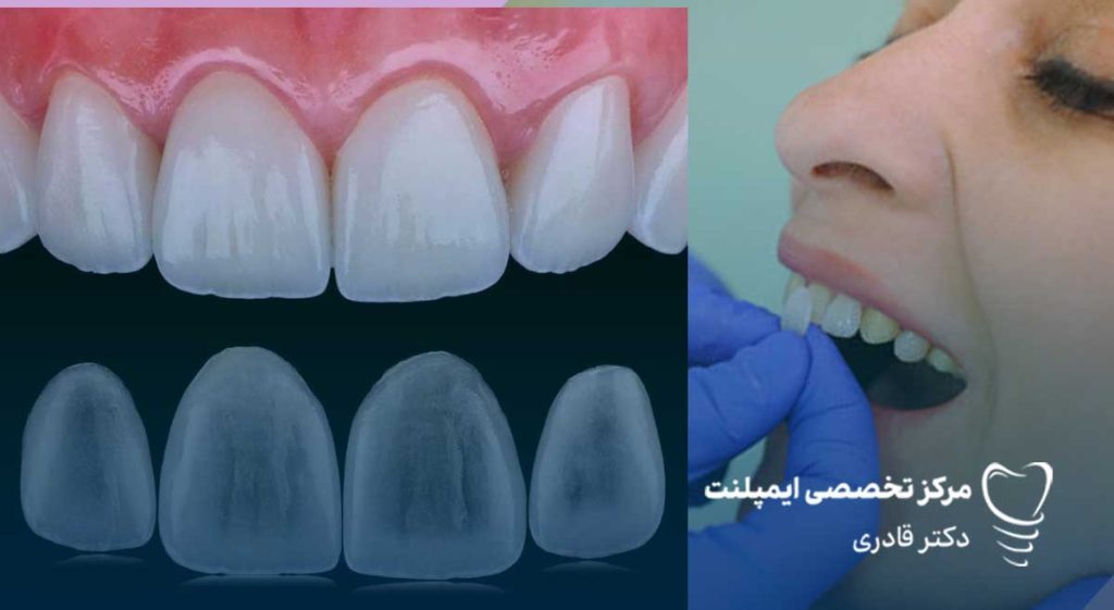 لمینت دندان سرامیکی