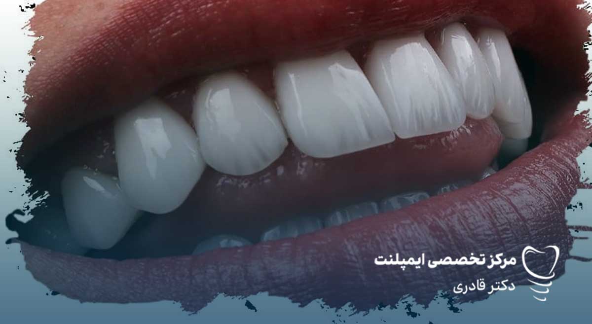 لمینت سرامیکی دندان