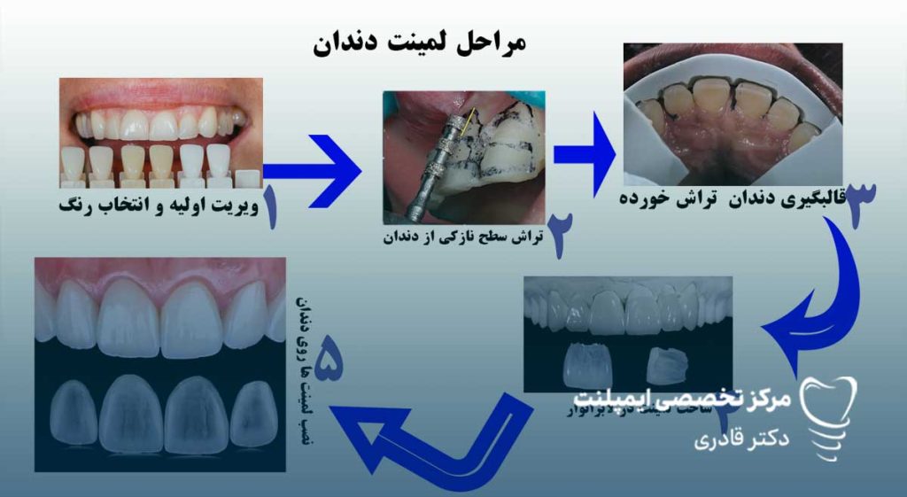 مراحل لمینت