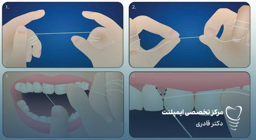تاثیر نخ دندان در سلامت لثه