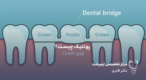 پونتیک دندان چیست