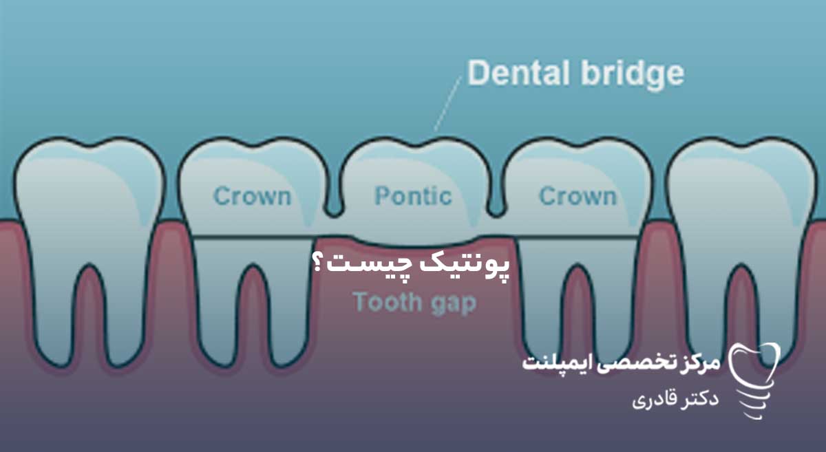 پونتیک دندان چیست