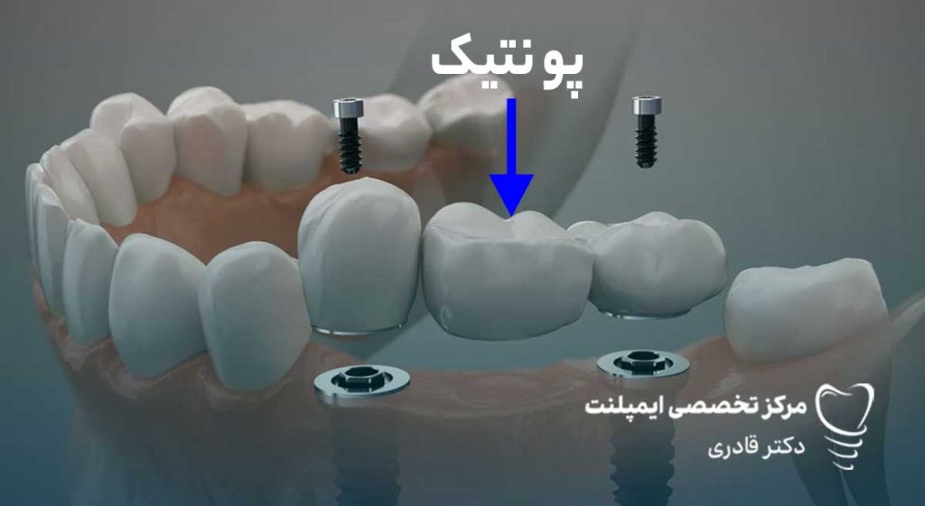پونتیک دندان چیست