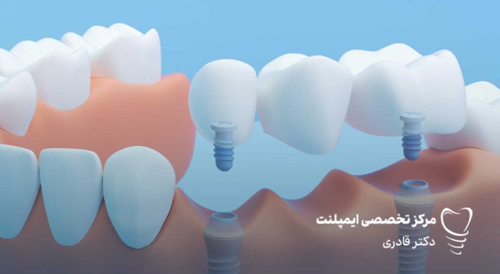 پونتیک دندان چیست