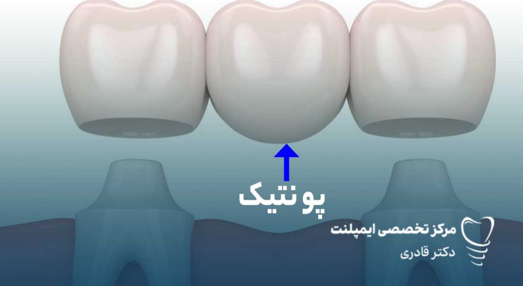 پونتیک دندان چیست