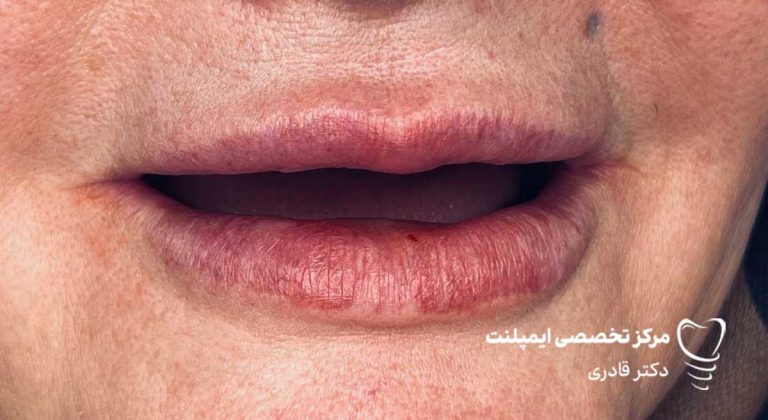 عکس ایمپلنت نمونه کار