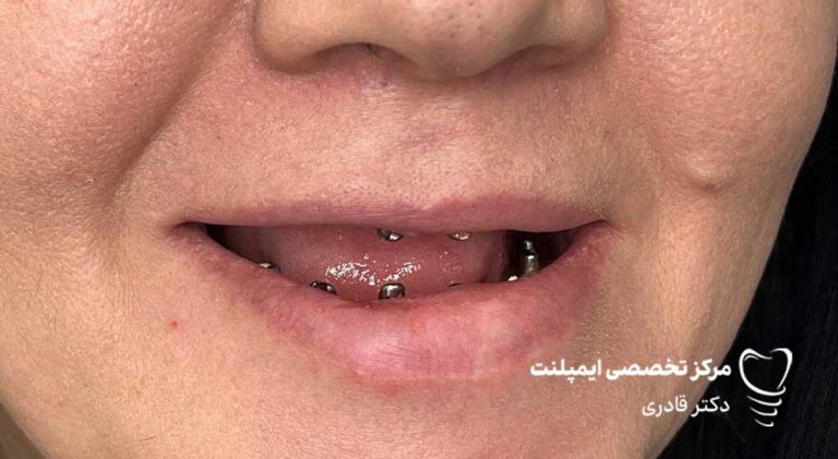 عکس ایمپلنت نمونه کار