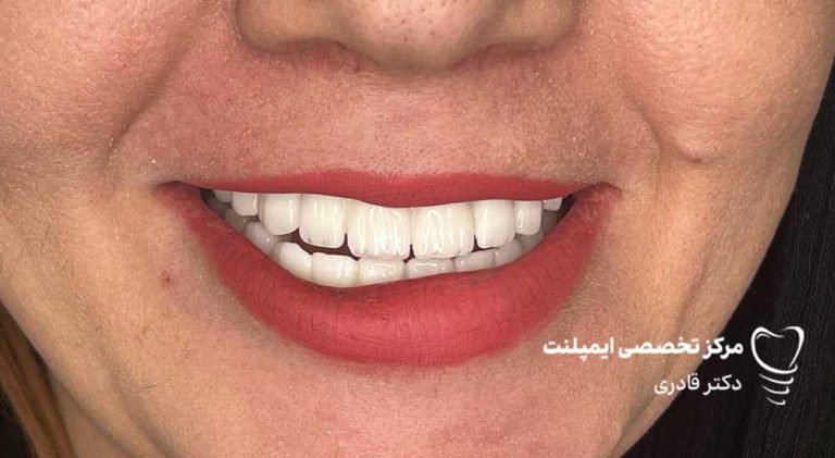 عکس ایمپلنت نمونه کار